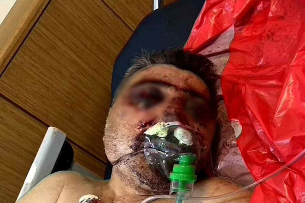 Turkish taxi driver left in coma after nose biting attack | Epicstorian News Turkish taxi driver brutally attacked by British tourist who allegedly bit off his nose during cab fare argument.