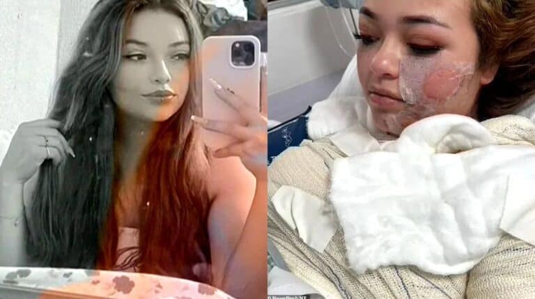 Woman wrapped in hospital bandages after hot tub burn injuries