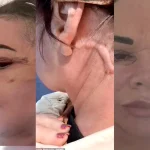 Scottish woman photographed before surgery after £7k Lithuania Facelift that she says resulted in complications