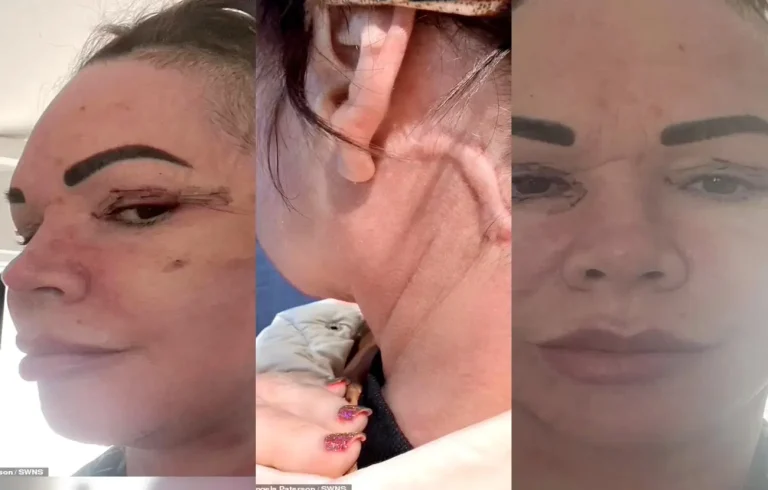 Scottish woman photographed before surgery after £7k Lithuania Facelift that she says resulted in complications